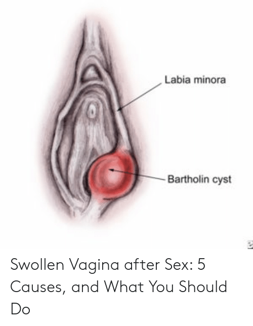 Stargazer reccomend vagina swollen sex